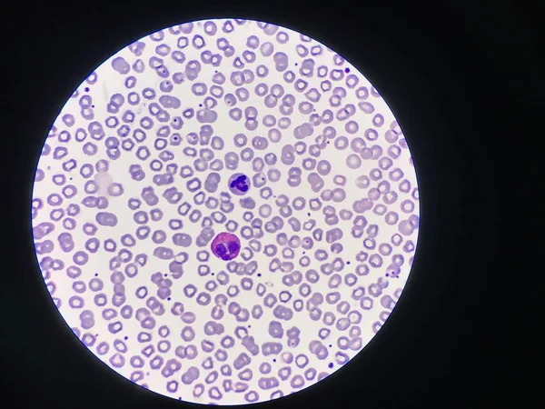 Összehasonlítás fehérvérsejtek eosinophil és neutrophil. — Stock Fotó