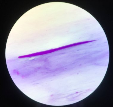 Slayt gösterisi Parazit Strongyloides stercoralis in balgam smear.