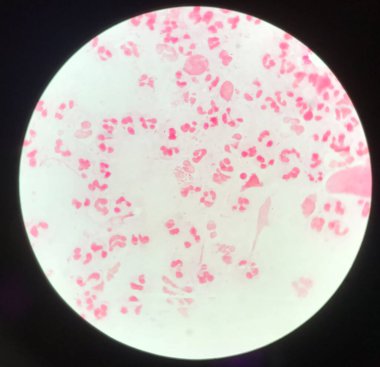 Slide show Gram negative diplococci in pus from penis. screening test for Neisseria gonorrhoeae sexually transmitted. screening test for Neisseria gonorrhoeae sexually transmitted.