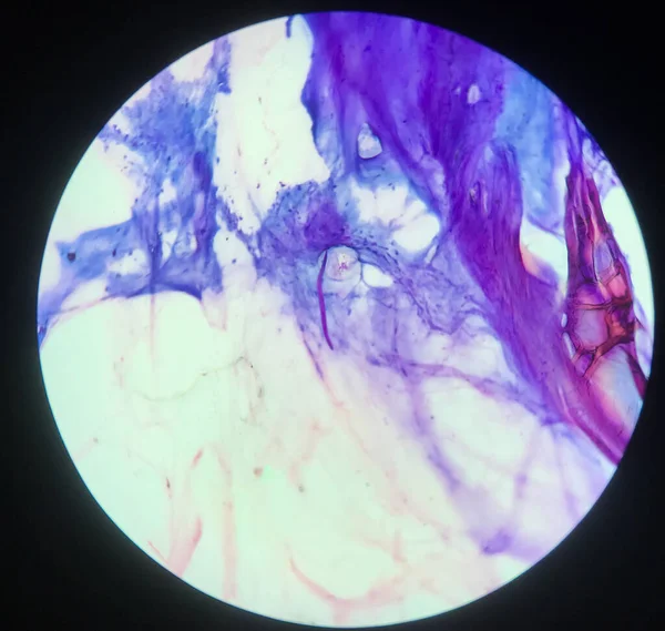 슬라이드에는 Parasite Strgongloides Stercoralis Sputum Smear — 스톡 사진