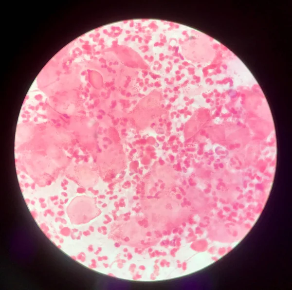 Glisați Arată Gram Diplococi Negative Puroi Din Penis Testul Screening — Fotografie, imagine de stoc