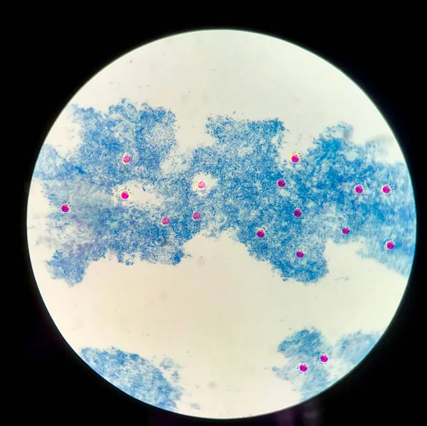 スライドはHiv患者の青い背景の暗号化コッカスに酵母の赤い細胞を示しています ロイヤリティフリーのストック画像