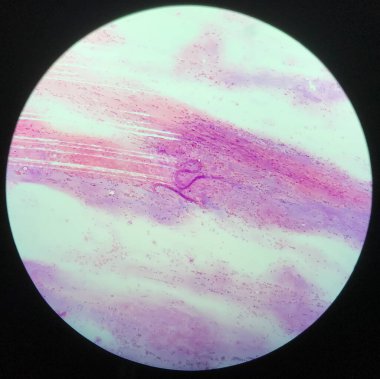 Stryloides stercoralis paraziti. Wright Lekesi 'ndeki balgam örneği..