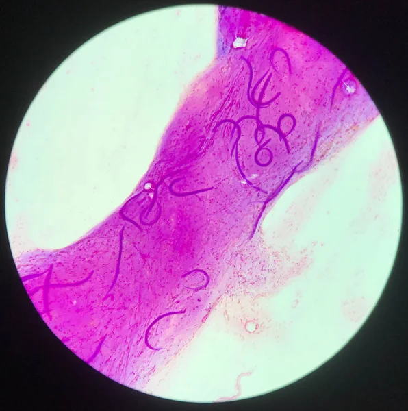 2018 Strongyloides Stercoralis Prosait Human Sputum Specimen Wright Stain — 스톡 사진