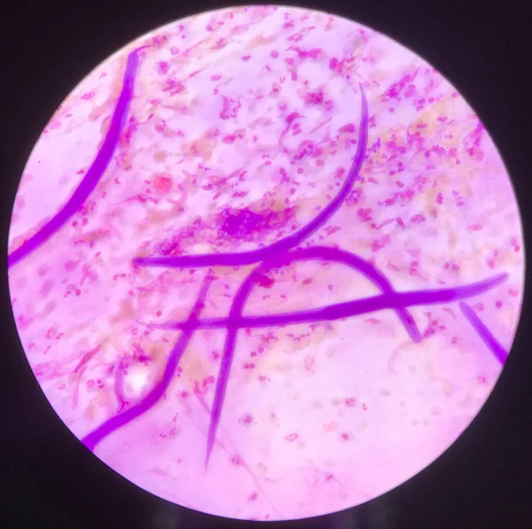 ヒトにおける強ヨウ化ステラリスの寄生虫 ライト染色におけるスプツム試験片 ロイヤリティフリーのストック写真