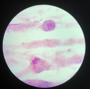 Stryloides stercoralis paraziti. Wright Lekesi 'ndeki balgam örneği..