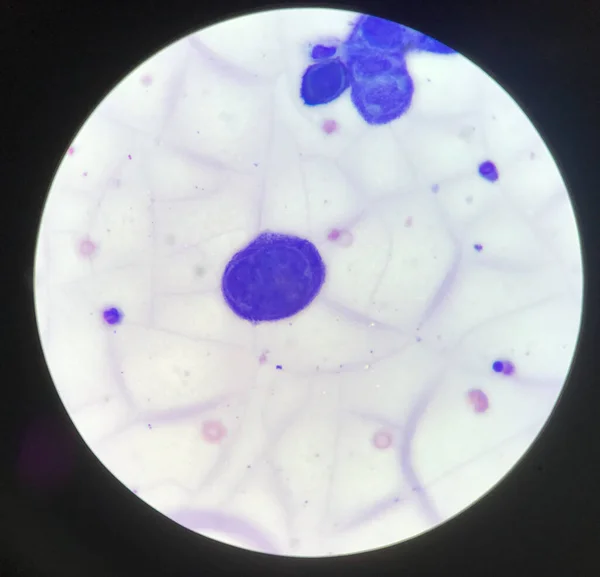 Tzanck 세포를 실험실에서 현미경으로 검사하는 — 스톡 사진