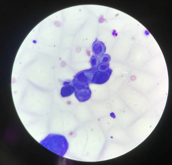Többmagvú Sejt Tzanck Vizsgálatban Mikroszkóppal Laboratóriumi Körülmények Között — Stock Fotó