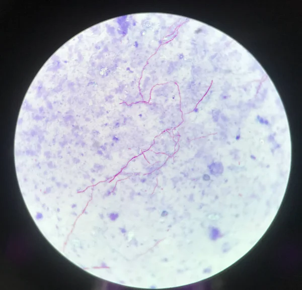 Ramificación Roja Micobacteria Tuberculosis Sobre Fondo Azul Tinción Rápida Bacilos —  Fotos de Stock