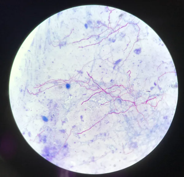 赤分岐菌結核の青色背景に修飾された酸高速細菌株 顕微鏡研究室の背景で見つける — ストック写真