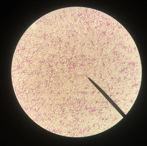 异常血细胞涂片科学概念 — 图库照片