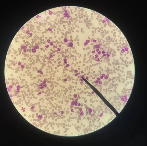 Abnormale Blutzellen Blutabstriche Wissenschaftliches Konzept — Stockfoto