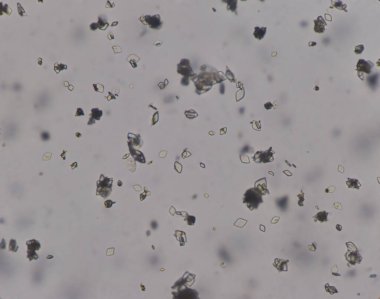 Orta dereceli idrar kristalleri..