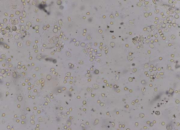 Rbc Wbc Des Bactéries Dans Urine Détectées Microscope — Photo