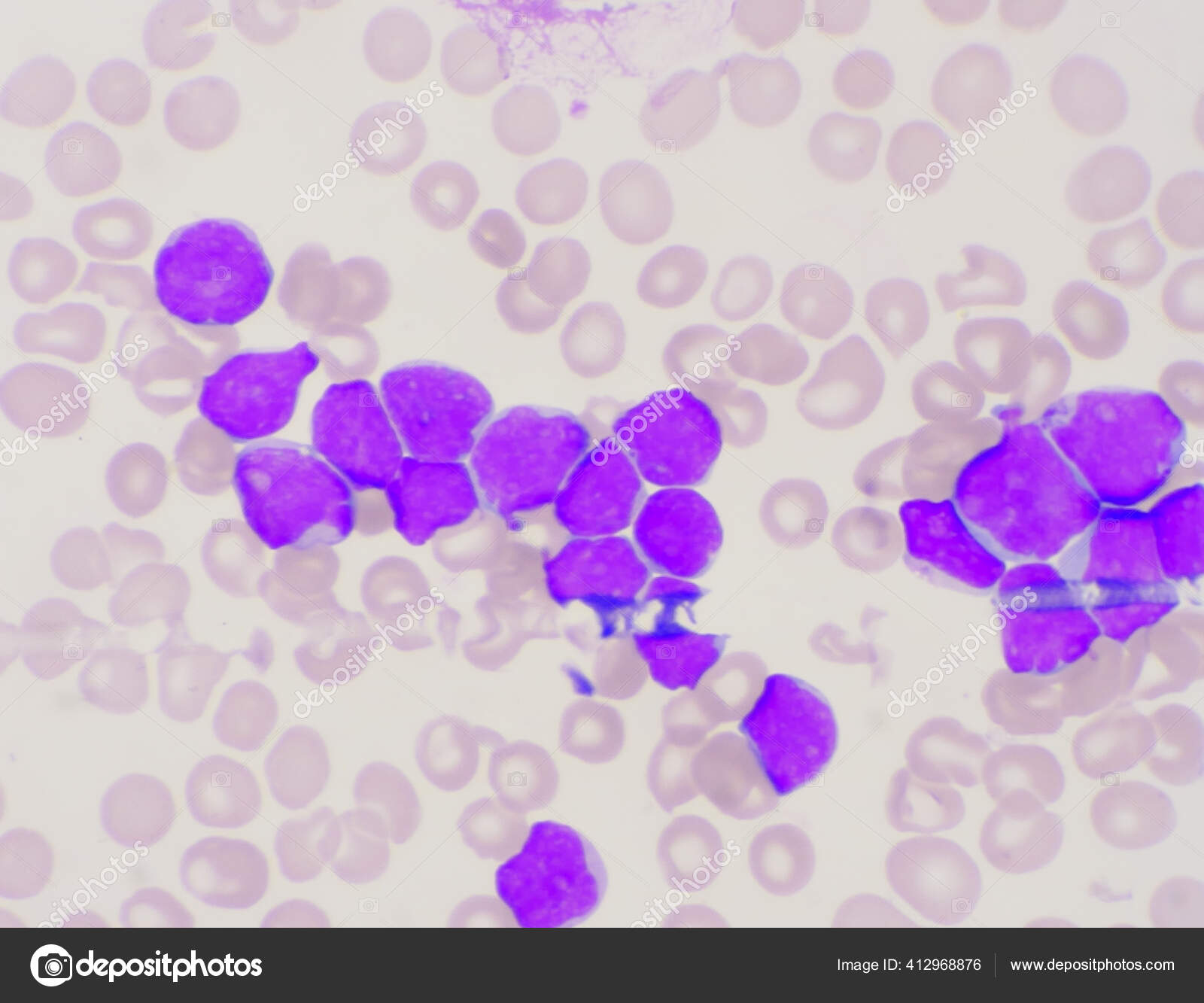 Group Blast Cells Leukemia Blood Smear Background Stock Photo by
