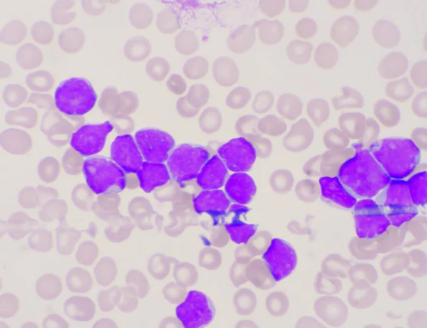 Gruppo Cellule Blastiche Sfondo Striscio Sangue Leucemia — Foto Stock