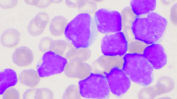 Group Blast Cells Leukemia Blood Smear Background — Stock Photo, Image