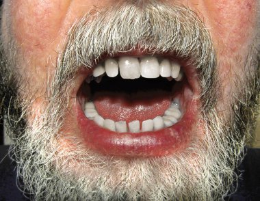 Sakallı ve ağzı açık, dişleri açık bir erkek yüzü..