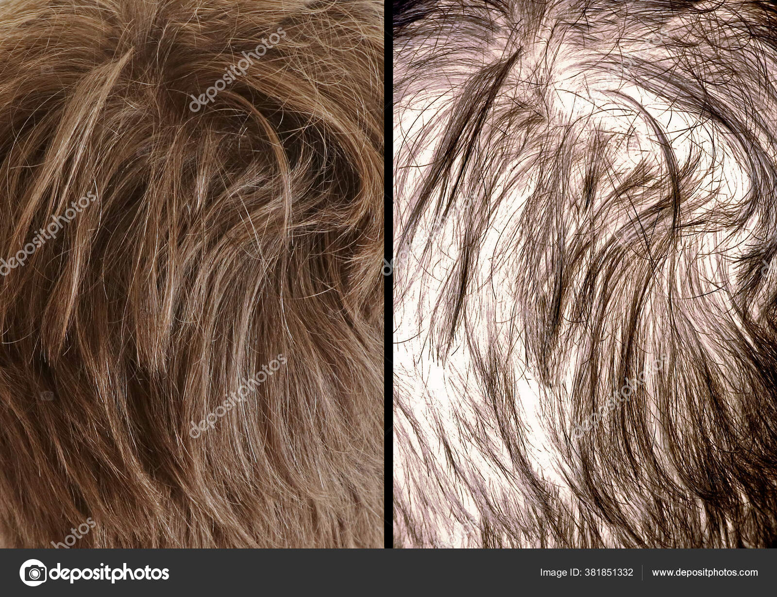 Comparison Thick Hair Thinning Hair Shoe Effects Hair Loss Stock Photo by ©Raydar 381851332 Comparison Thick Hair Thinning Hair Shoe Effects Hair Loss Stock Photo by ©Raydar 381851332