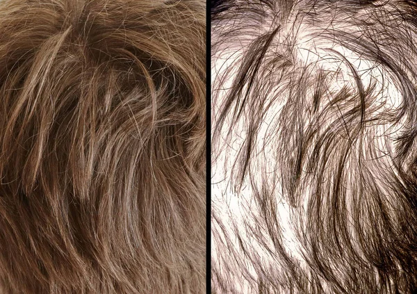 A comparison of thick hair and thinning hair to shoe the effects of hair loss