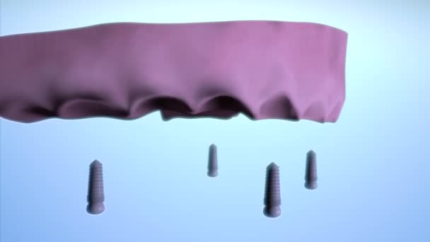3D可視化により 歯科用インプラント オールオン4 オールオン6の治療方法のアニメーションを作成し 歯科用義歯によるすべての歯の修復 — ストック動画