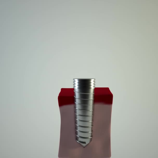 歯科用インプラントアニメーション3D可視化レンダリング インプラント治療法 歯科用義歯による歯の修復 — ストック動画