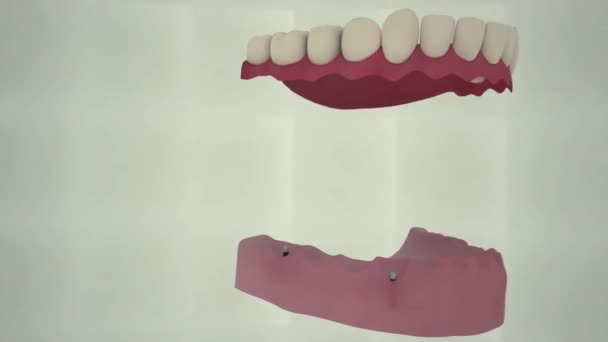 歯科用着床アニメーション3D可視化レンダリング All All 治療方法 歯科用義歯によるすべての歯の修復 — ストック動画