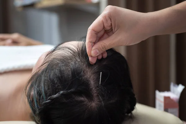 Acupuntura Cabeza Hair Glabrous —  Fotos de Stock
