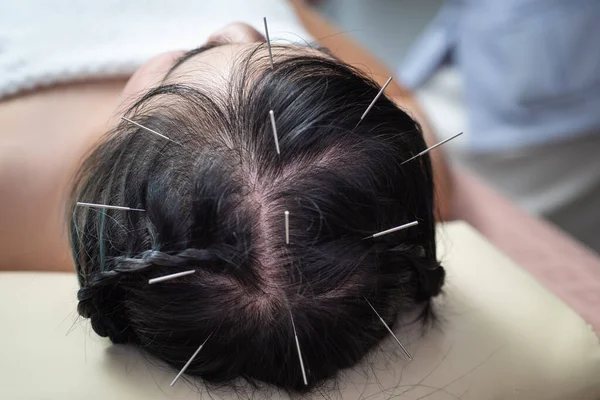 頭への鍼治療 Hair Glabous — ストック写真