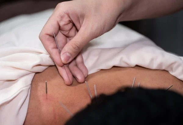 Akupunktur Massage Trockene Nadeln Behandlung — Stockfoto