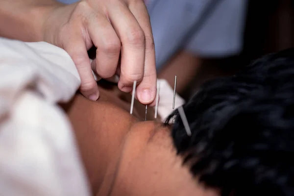 Akupunktur Massage Trockene Nadeln Behandlung — Stockfoto