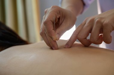 Yakın plan genç bayan akupunktur tedavisi görüyor.