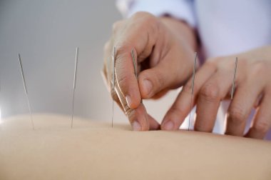 Yakın plan genç bayan akupunktur tedavisi görüyor.