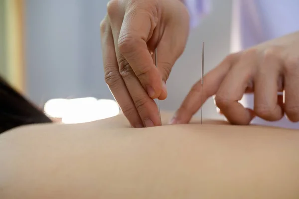 Nahaufnahme Junge Frau Erhält Akupunktur Behandlung — Stockfoto