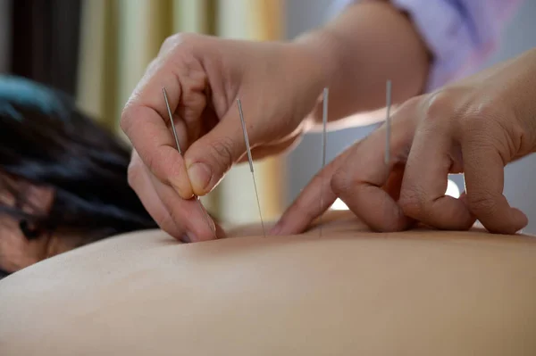 クローズアップ若い女性が鍼治療を受ける — ストック写真