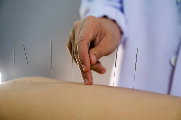 Nahaufnahme Junge Frau Erhält Akupunktur Behandlung — Stockfoto