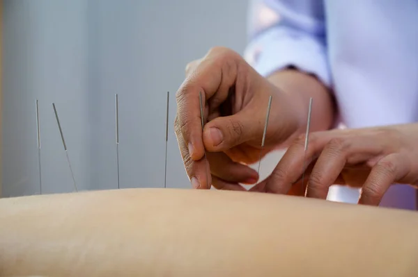 Nahaufnahme Junge Frau Erhält Akupunktur Behandlung — Stockfoto