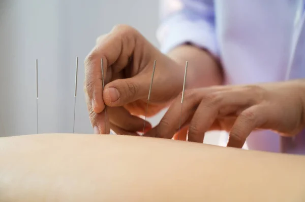 Nahaufnahme Junge Frau Erhält Akupunktur Behandlung — Stockfoto