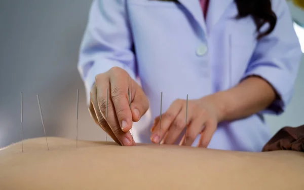 Primer Plano Mujer Joven Recibiendo Tratamiento Acupuntura — Foto de Stock