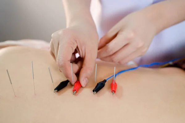 Electro Agopuntura Agopuntura Tradizionale Cinese Electro Agopuntura Sul Corpo Del — Foto Stock