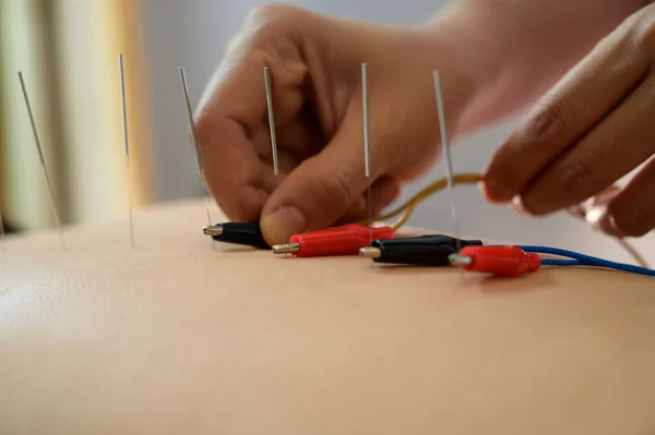 Elektro-Akupunktur. Geleneksel Çin akupunkturu ve hasta vücudunda elektro akupunktur.