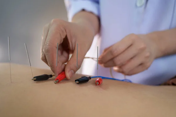 Elektro Akupunktur Traditionelle Chinesische Akupunktur Und Elektro Akupunktur Körper Des — Stockfoto
