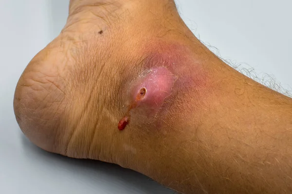 Abscesses form after bacteria. Infected purulent open wound on the mans foot. — Stock Photo, Image