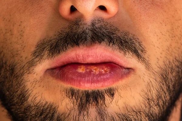 Foto de close-up de dor fria dolorosa ou vírus do herpes no lábio do homem. — Fotografia de Stock