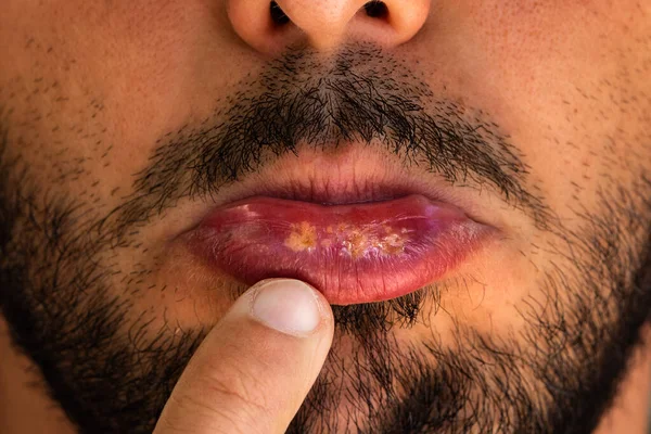 Homem mostra dor de frio doloroso ou vírus herpes em seu lábio. — Fotografia de Stock