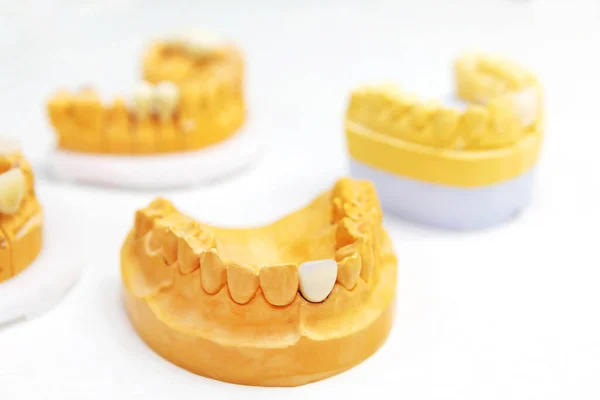 Implant Dentystyczny Robią Protezy Laboratorium Dentystycznym Szczęka Zębami Białym Tle — Zdjęcie stockowe