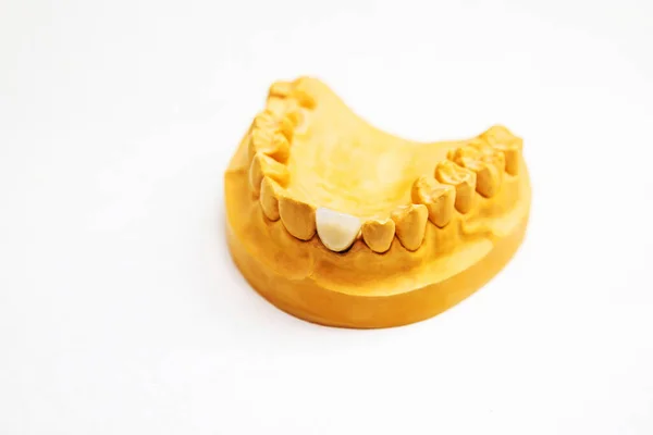 Implant Dentystyczny Model Szczęki Sztucznym Zębem — Zdjęcie stockowe