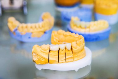 Diş kaplamaları. Yapay diş üretimi