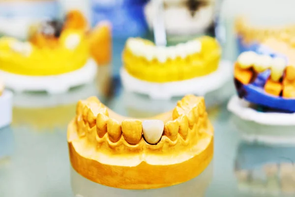 Implant Dentystyczny Robię Sztuczną Szczękę Sztuczny Ząb Układzie Szczęki Przywracanie — Zdjęcie stockowe