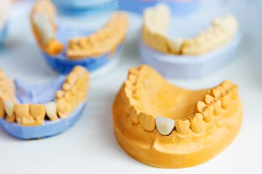 Diş implantı olan bir insanın çene yapısı. Diş üretimi ve protezleri. Diş Laboratuvarı.
